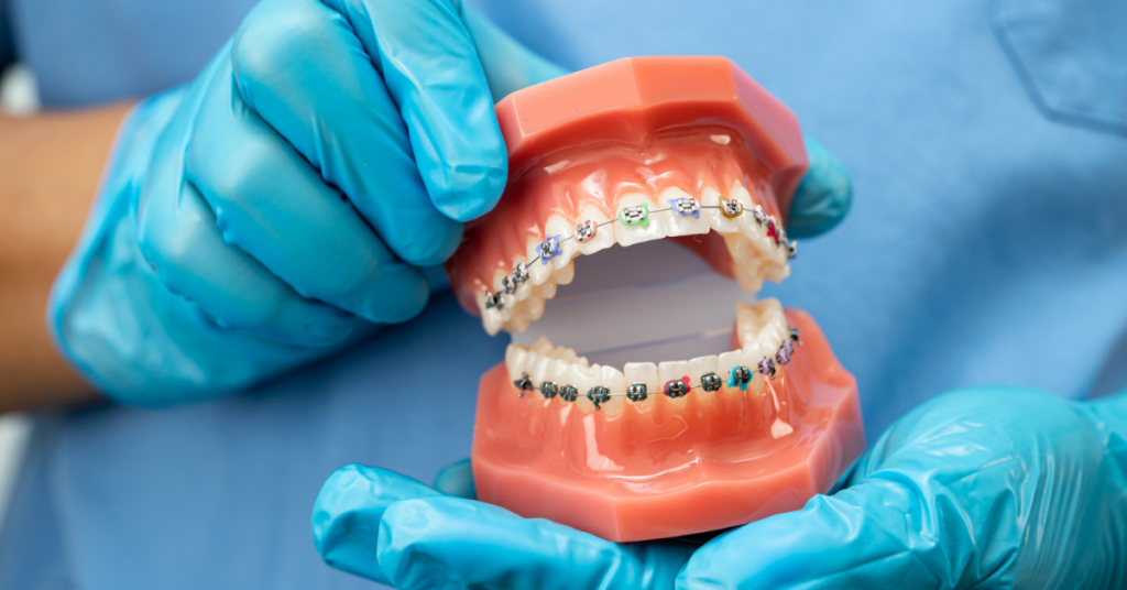 Braces FAQs Everything Encino, Glendale & Pasadena Patients Want to Know