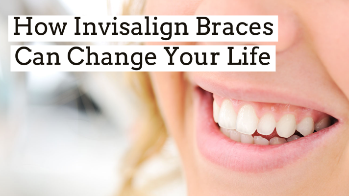 Orthodontics LA - How Invisalign Braces Can Change Your Life