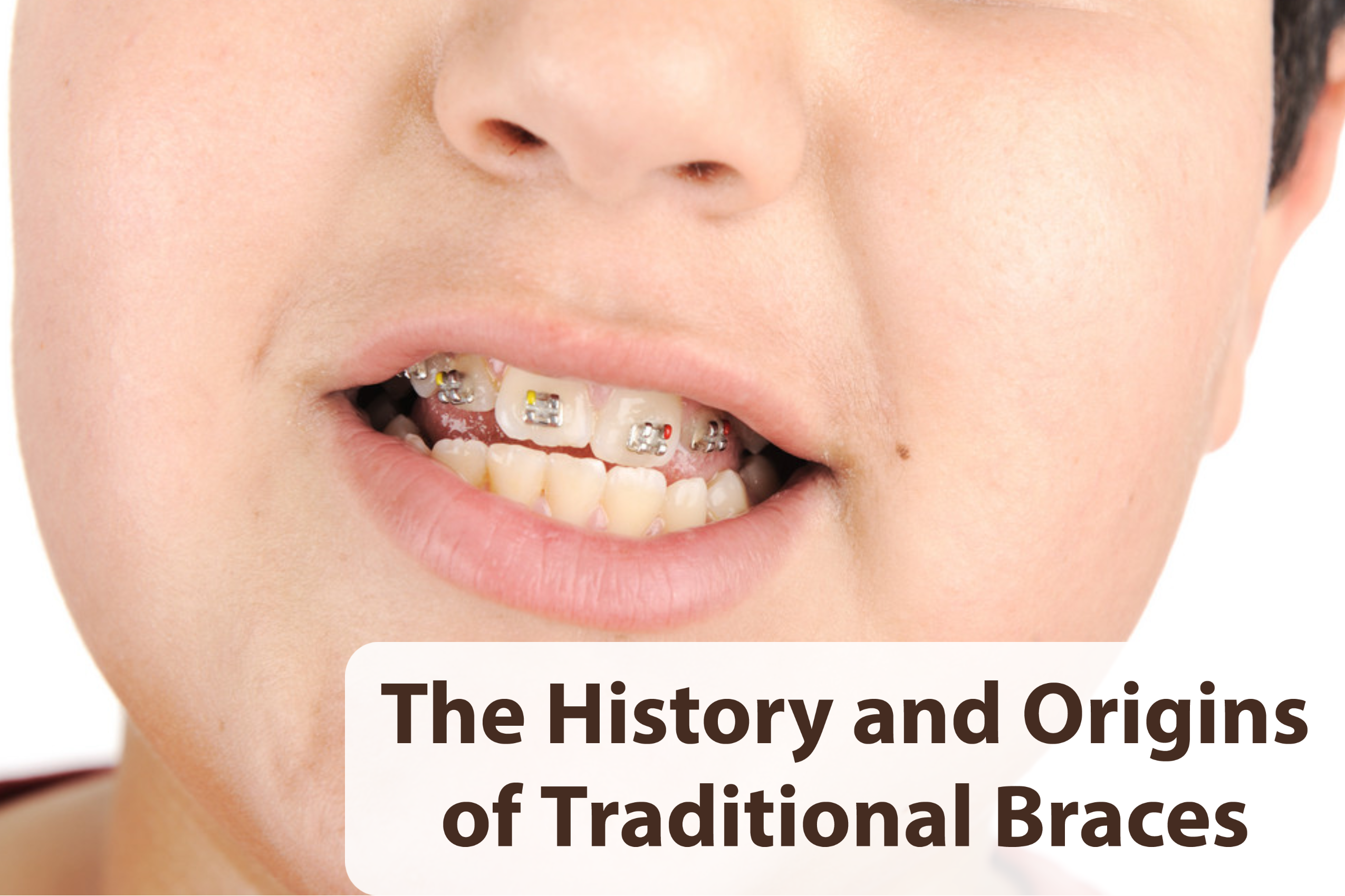 Orthodontics LA -The History and Origins of Traditional Braces