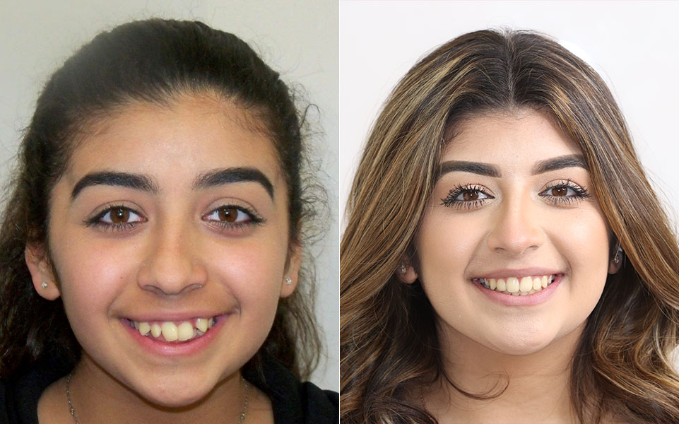 Before and After Orthodontist Patient