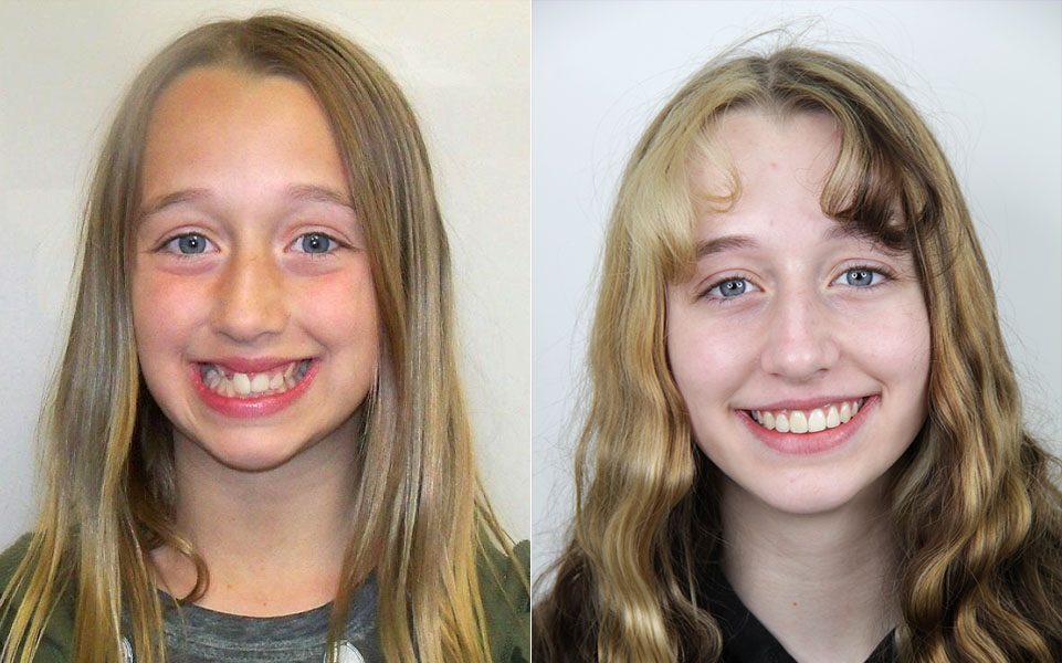 Before and After Orthodontist Patient