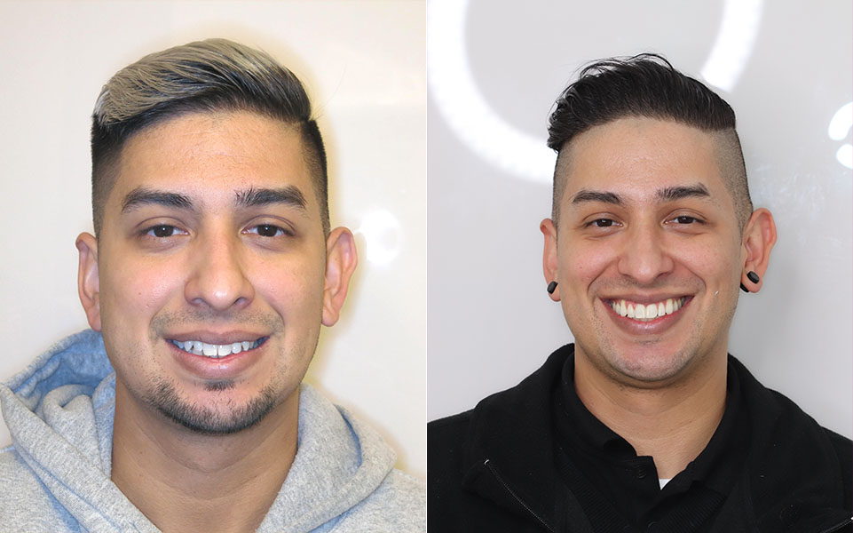 Before and After Orthodontist Patient