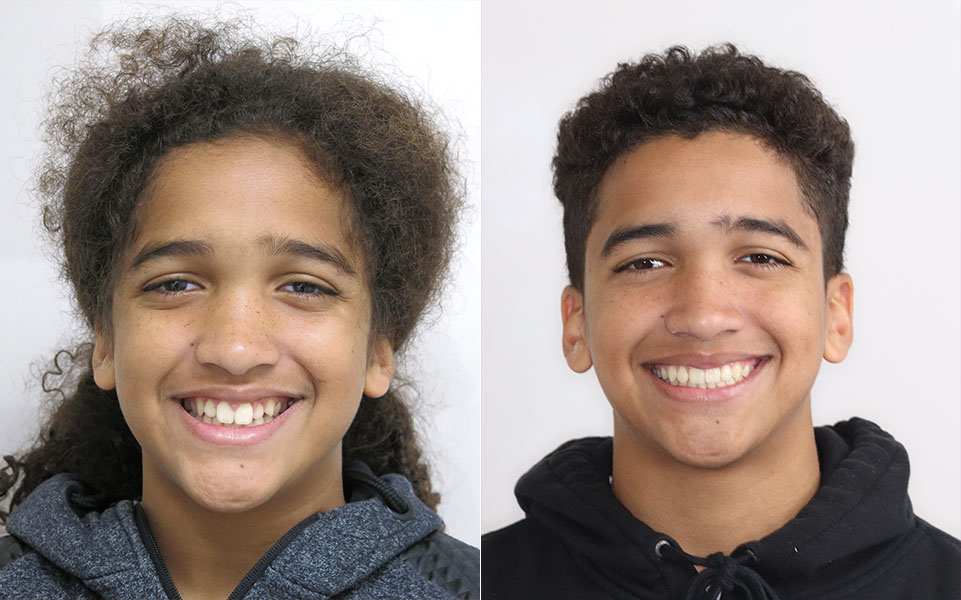 Before and After Orthodontist Patient