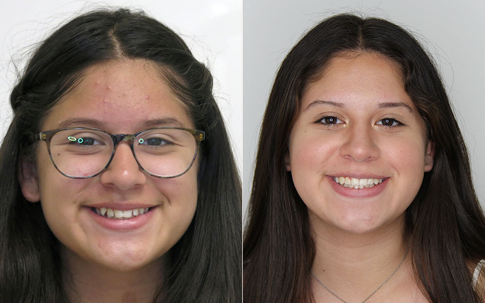 Before and After Orthodontist Patient