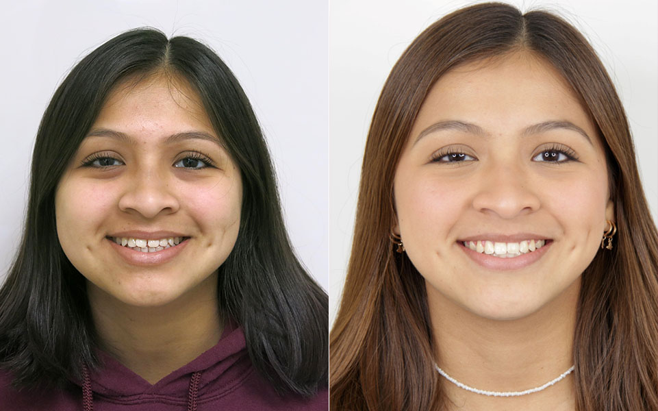 Before and After Orthodontist Patient