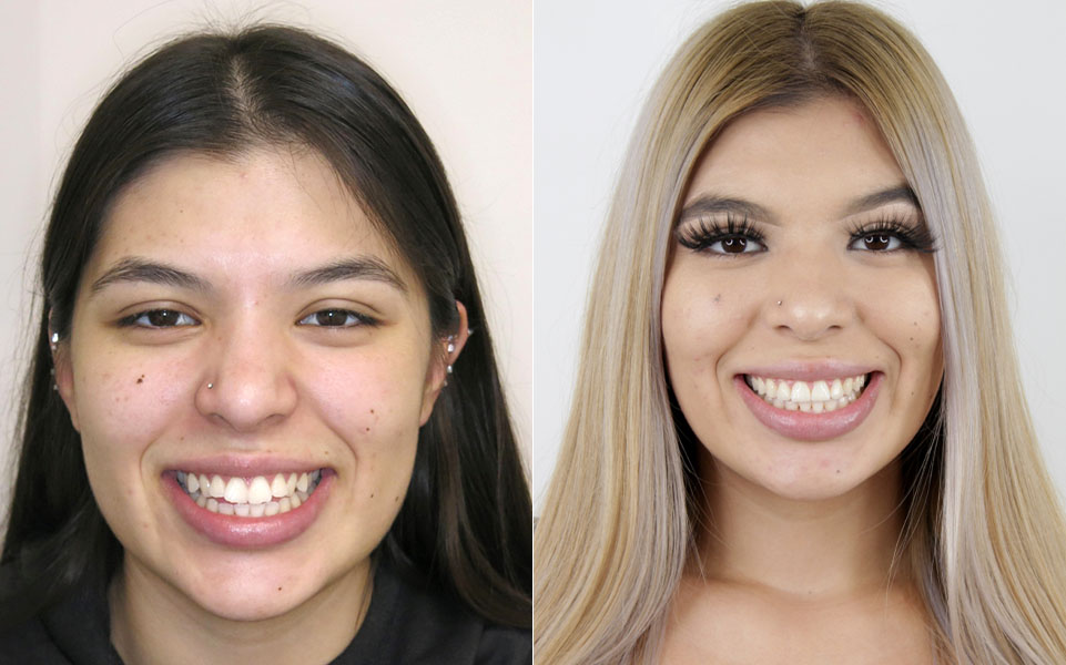 Before and After Orthodontist Patient