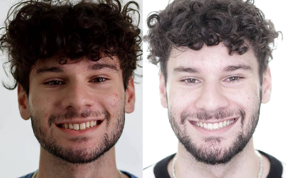 Meserkhani Before and After