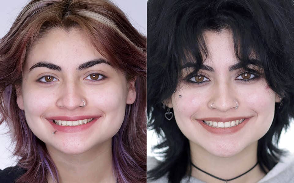 Meserkhani Before and After