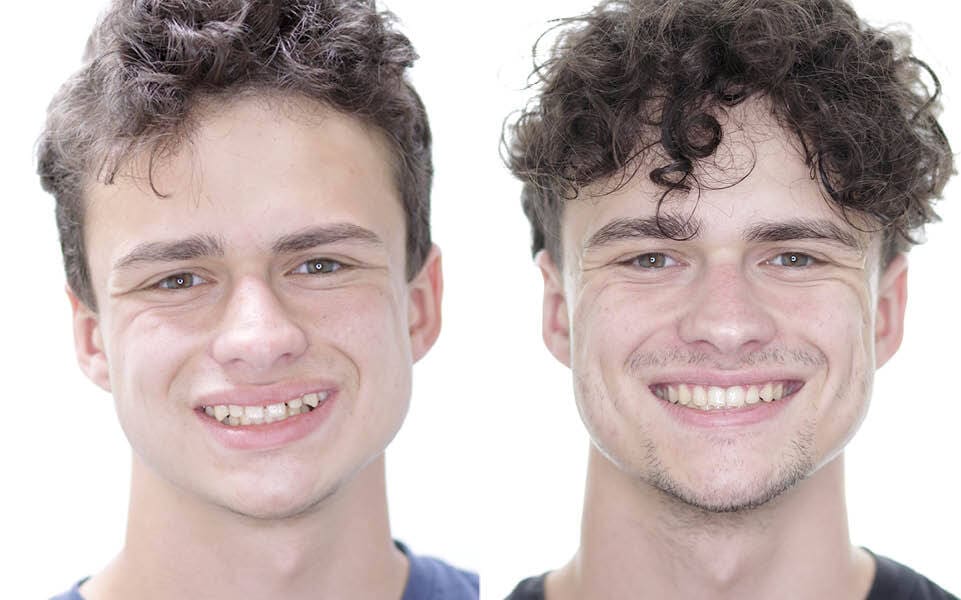 Meserkhani Before and After