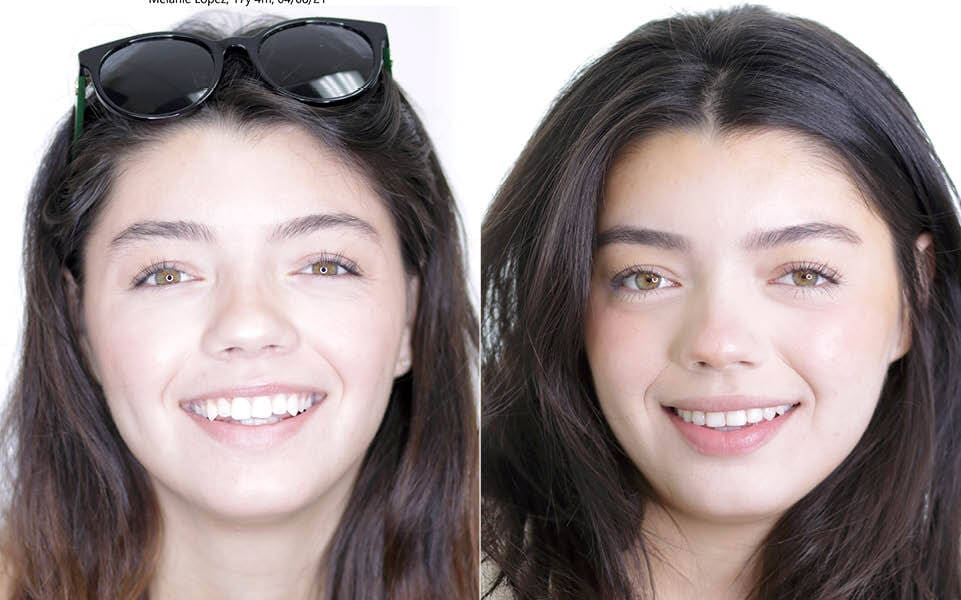 Meserkhani Before and After