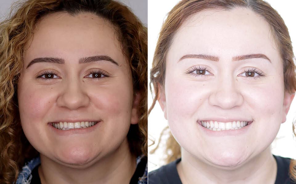 Meserkhani Before and After