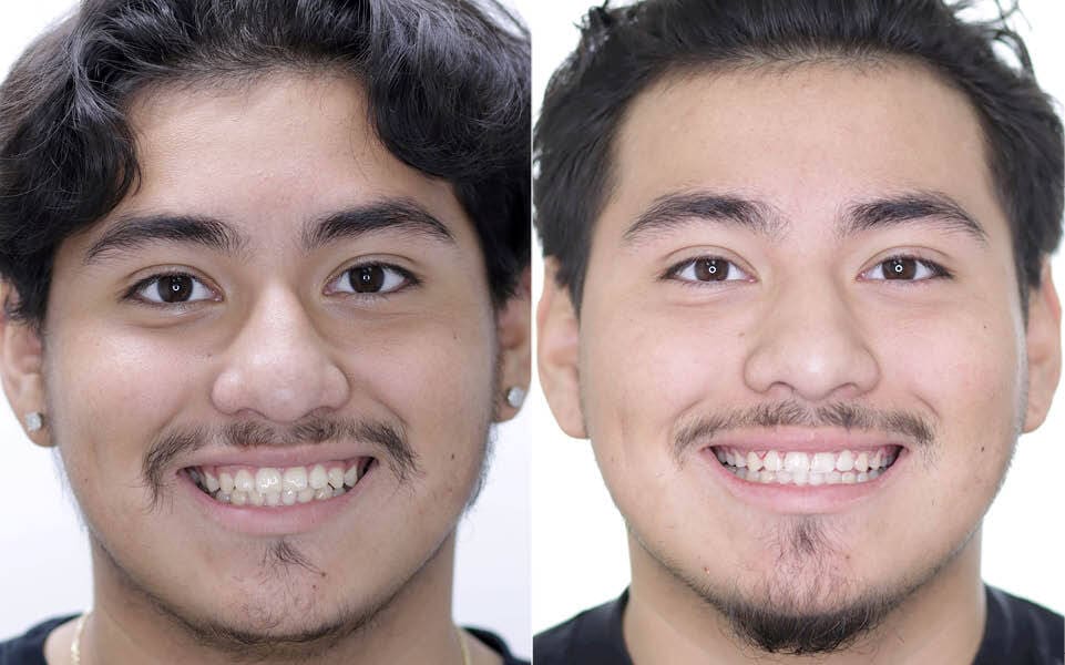Meserkhani Before and After