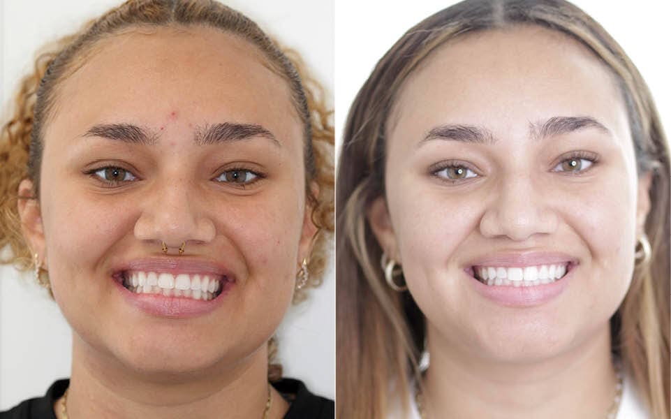 Meserkhani Before and After