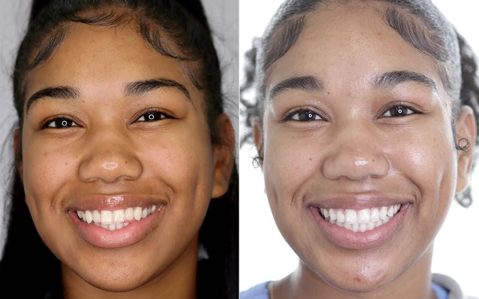 Meserkhani Before and After